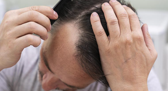 핀페시아 공식 직구몰: 안전하고 신뢰할 수 있는 탈모 치료제의 정석